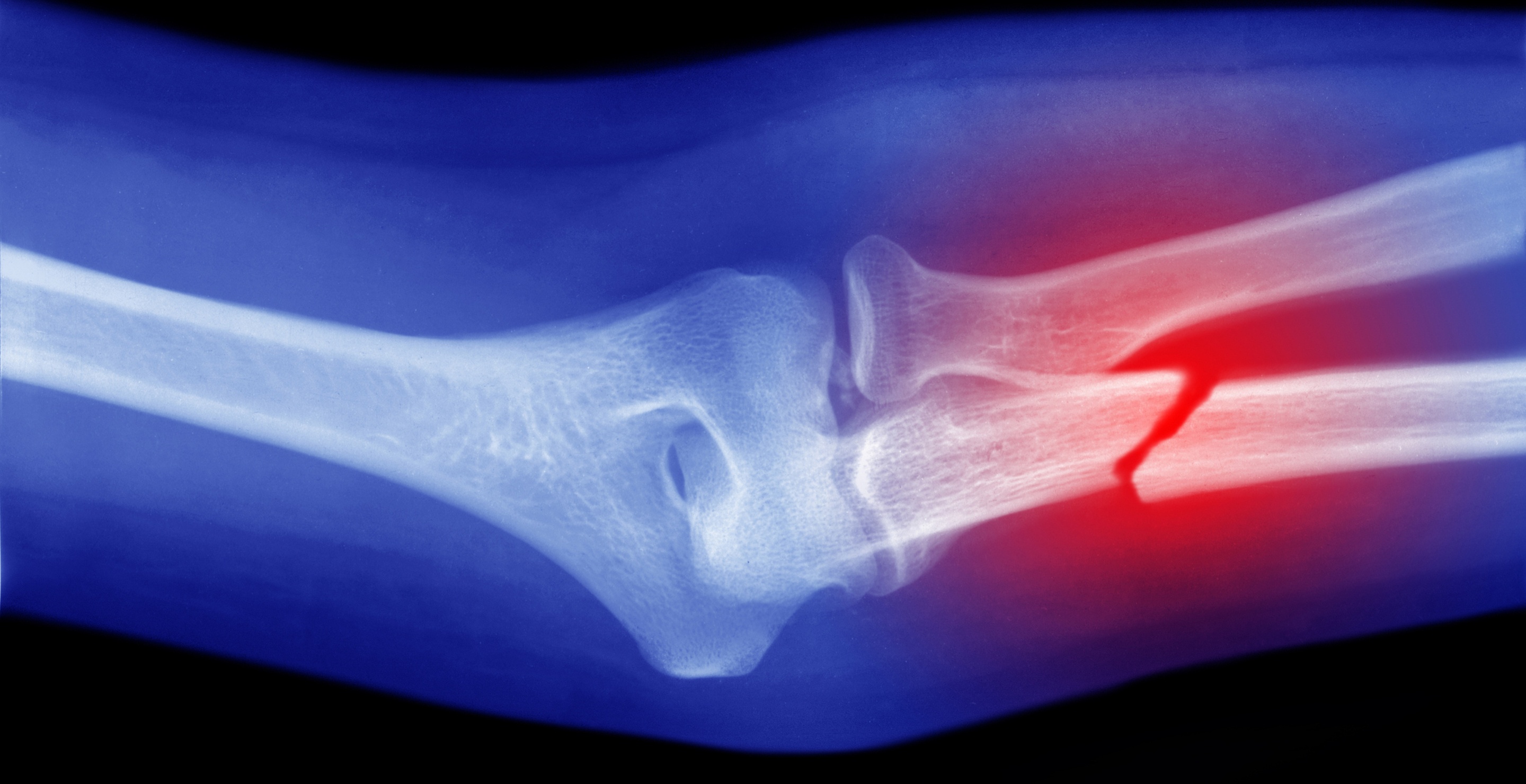 Popular Drug, Second Most Commonly Prescribed To Older Adults, Linked To Bone Loss