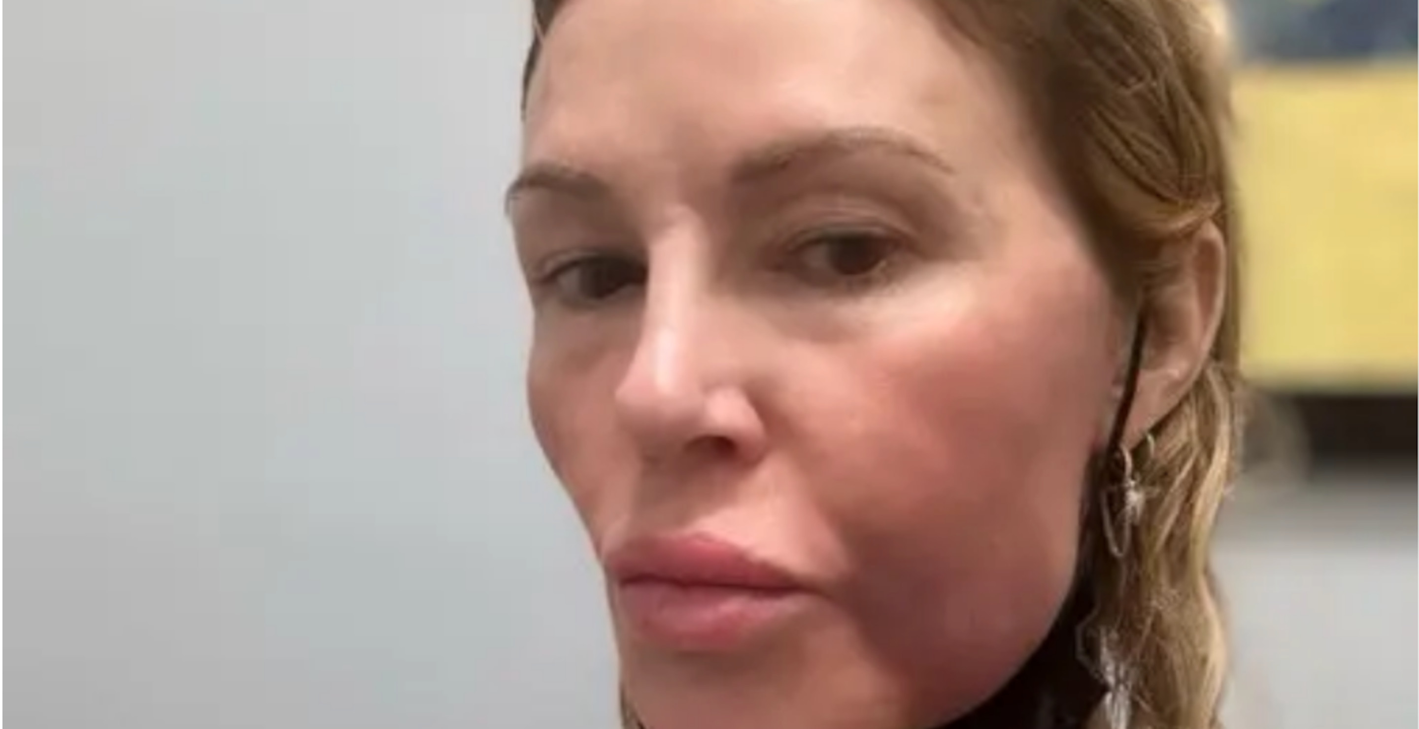 Brandi-Glanville-Reveals-Facial-Disfigurement-Has-Affected-Love-Life