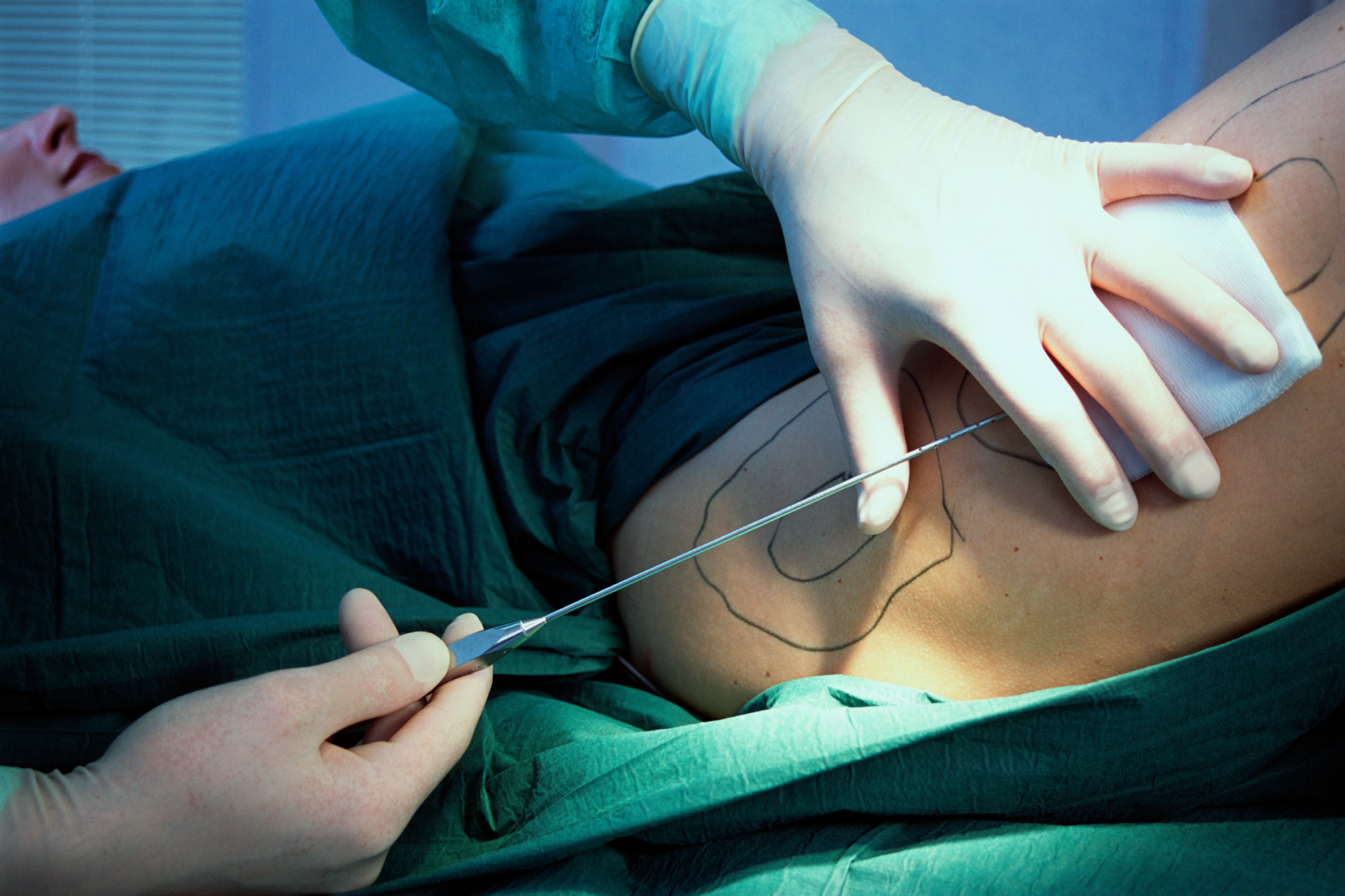 Woman Dies While Undergoing Liposuction At Home