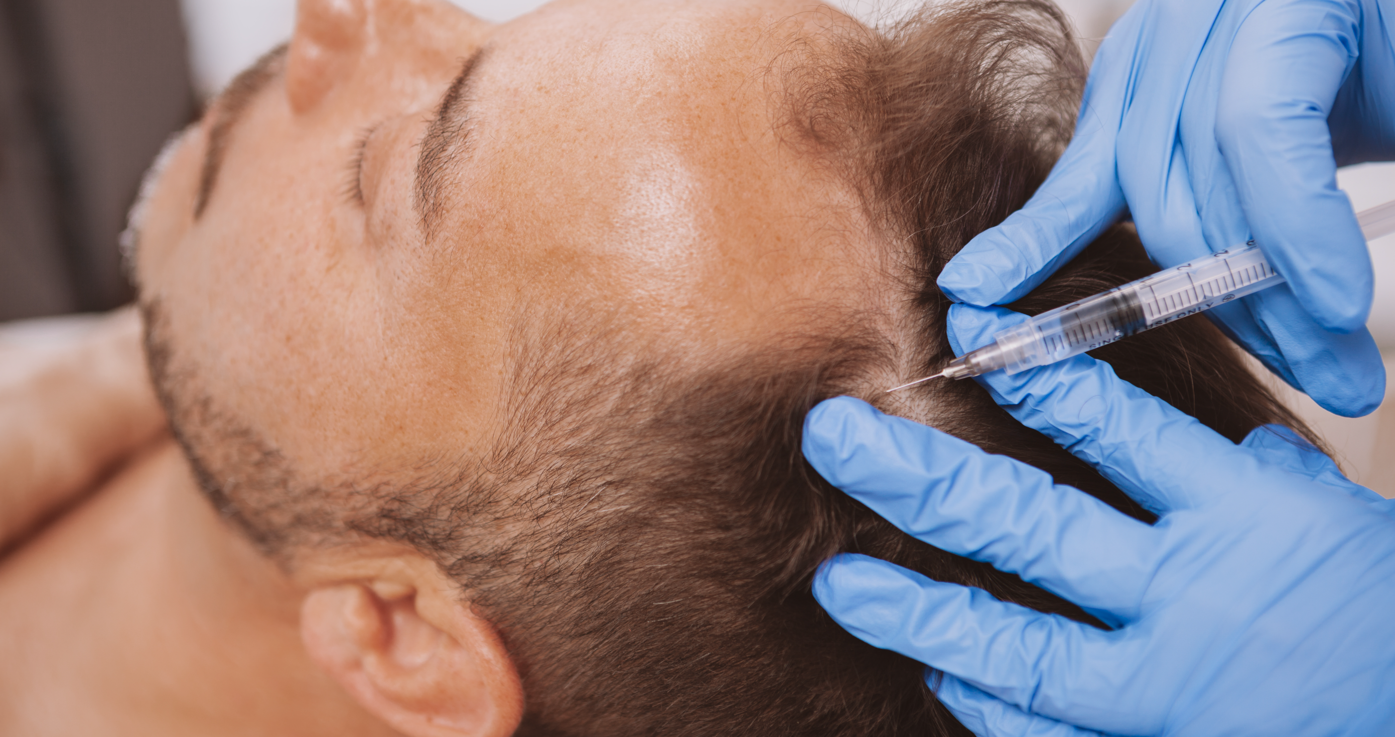 infants werewolf condition from hair loss drug