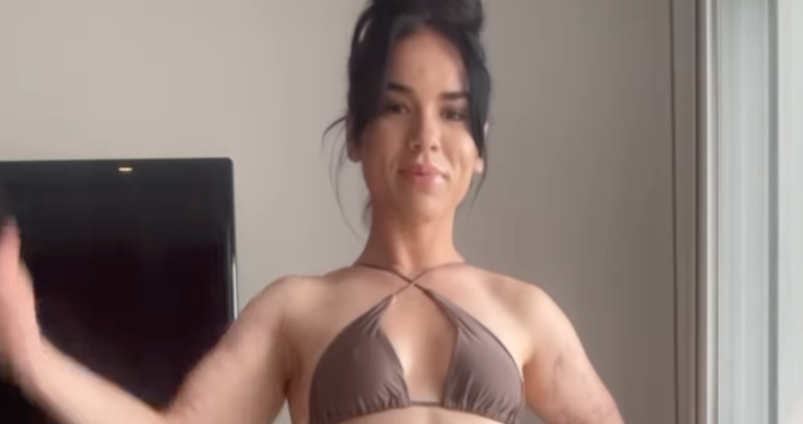 model contracts flesh eating bacteria from weight loss shot