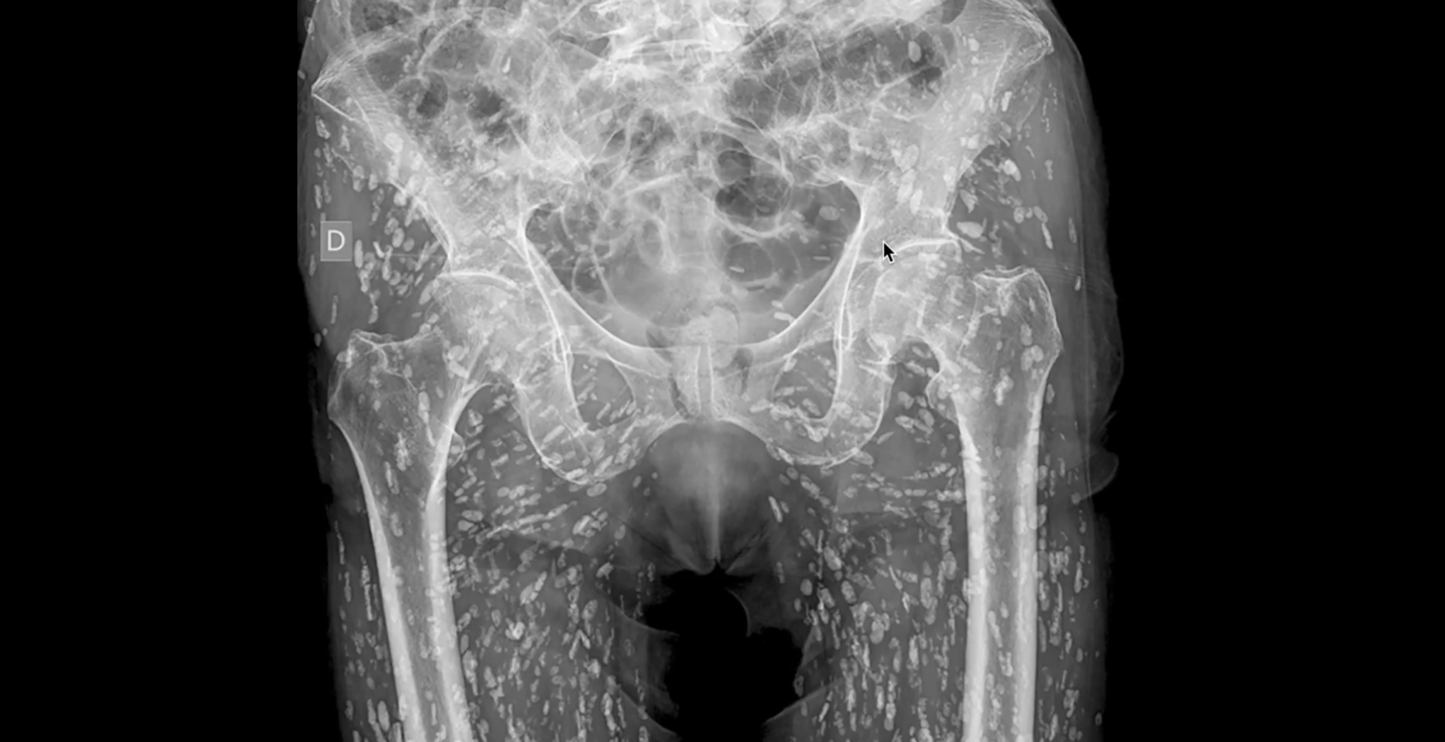 Terrifying X-Ray Shows Patient's Body Overrun With Parasitic Worms