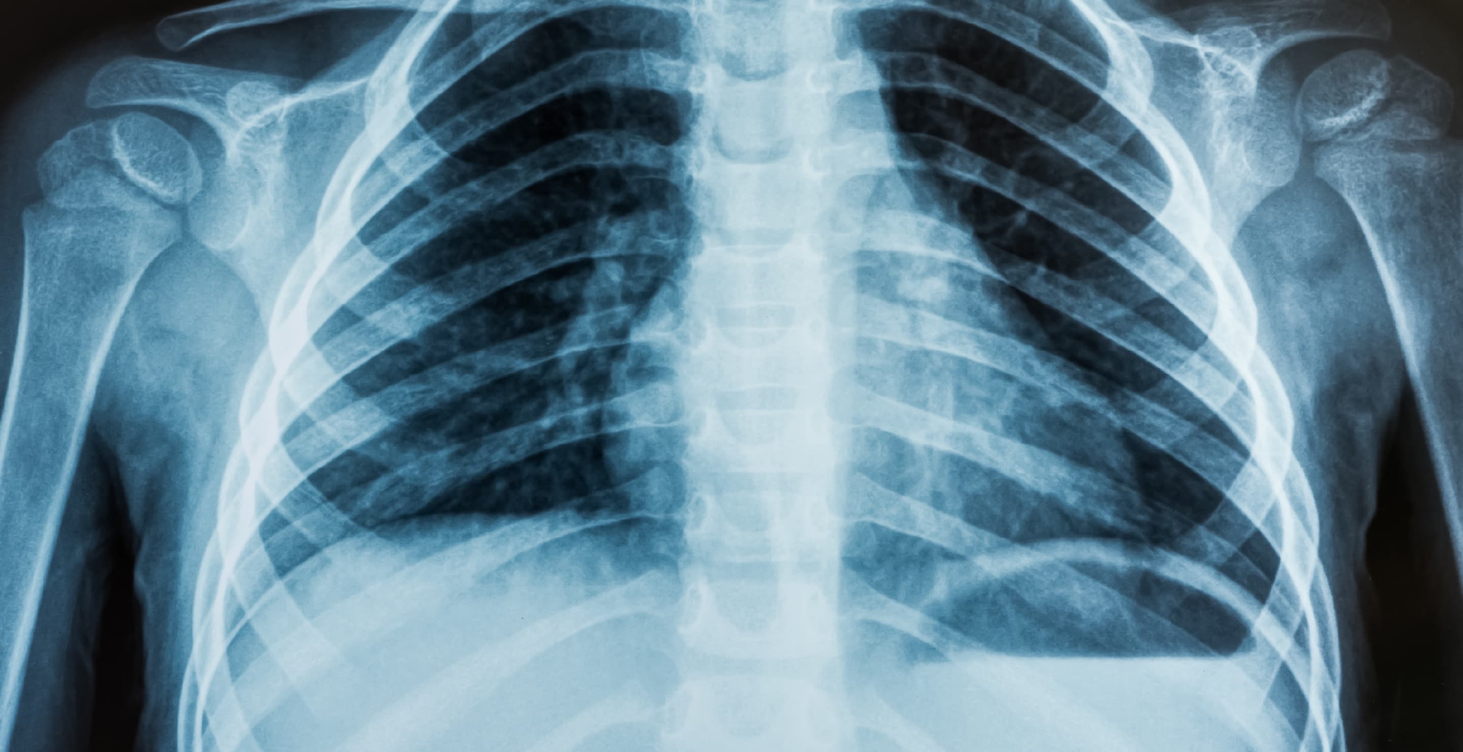 Chest X-Ray