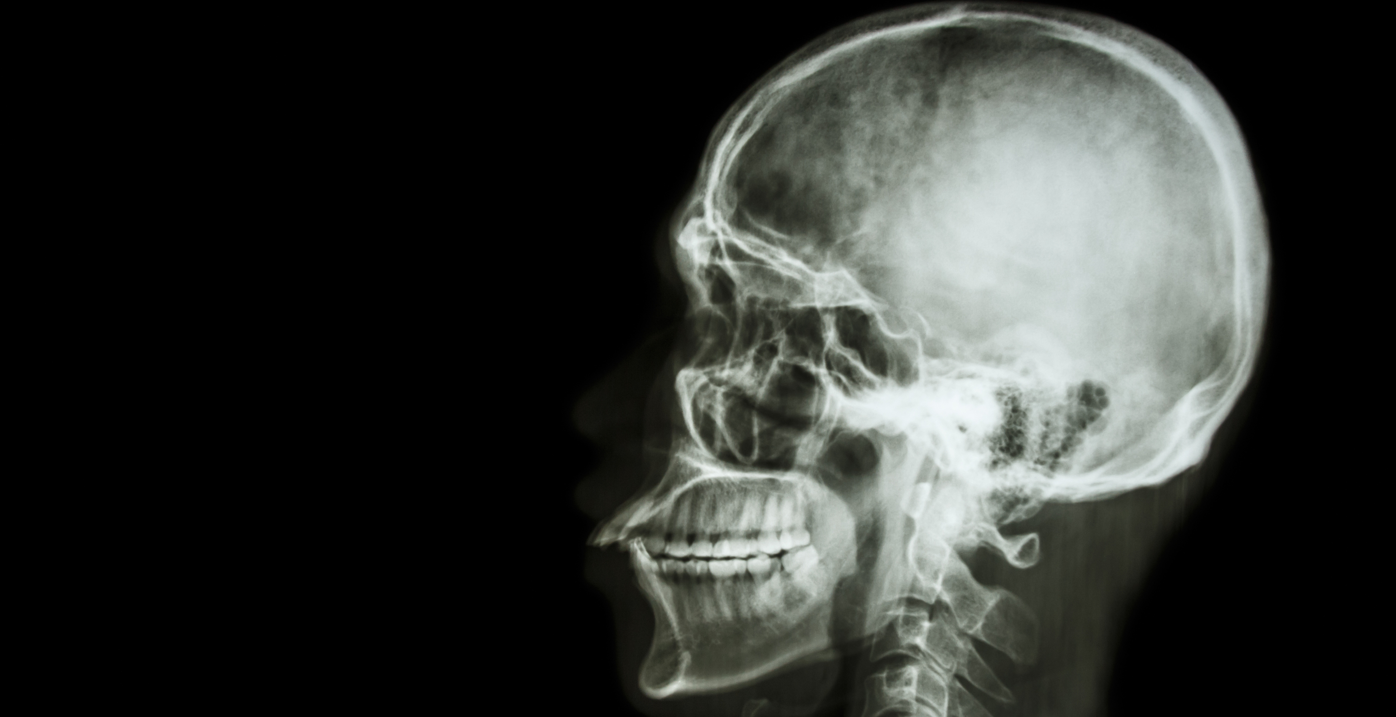 Farmer Has Skull Reattached After Suffering Internal Decapitation During Car Wreck