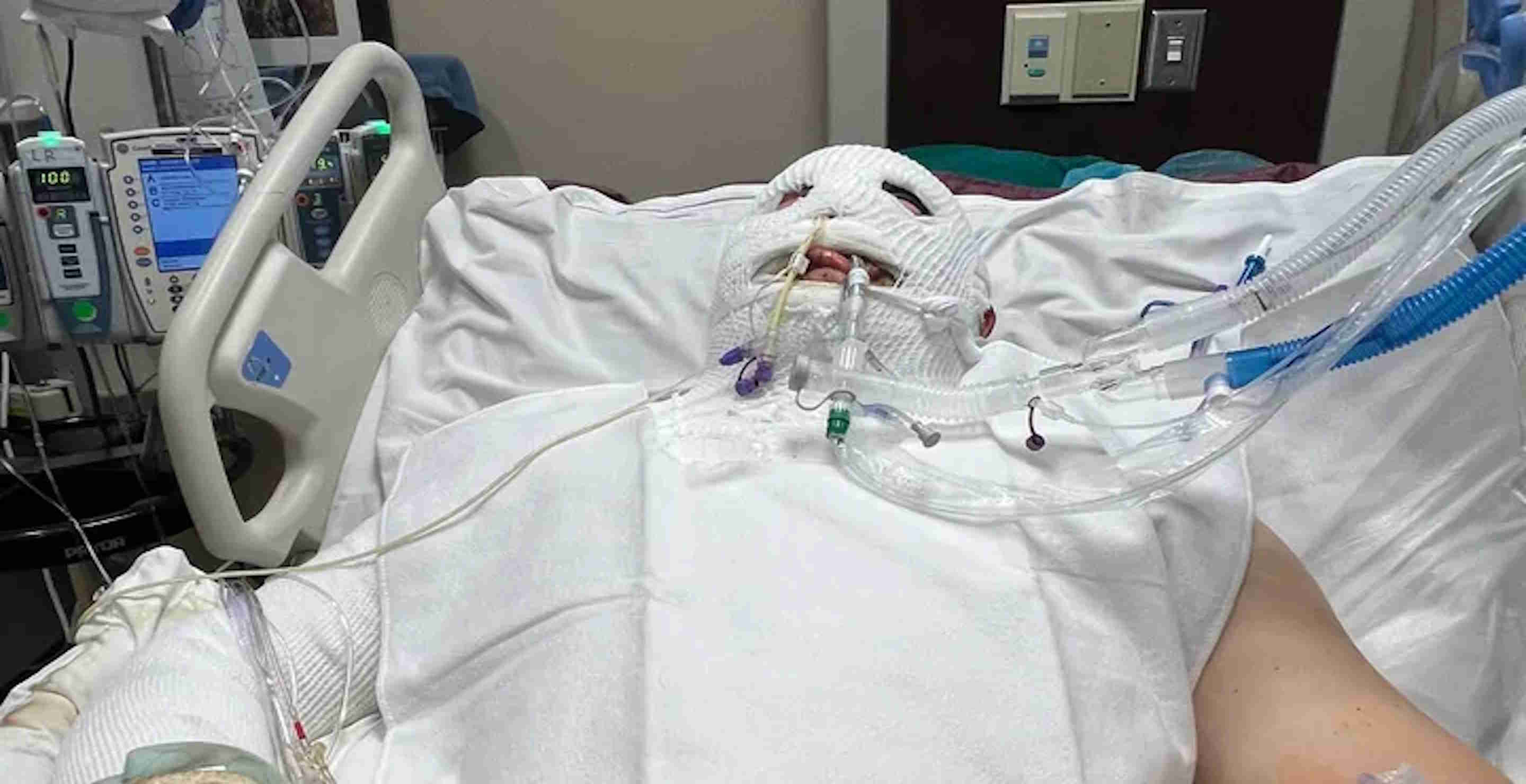 Man Severely Burned And In Coma After Backyard Bonfire Gone Wrong