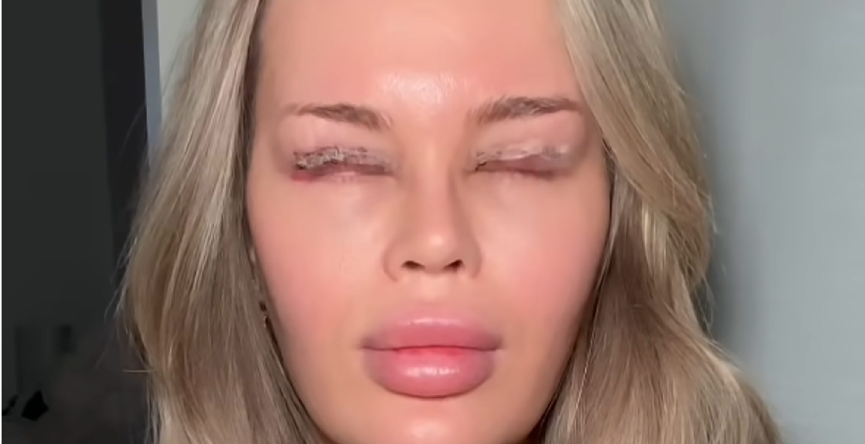 YouTube Star Experiences Gruesome Side Effects After Eyelid Surgery