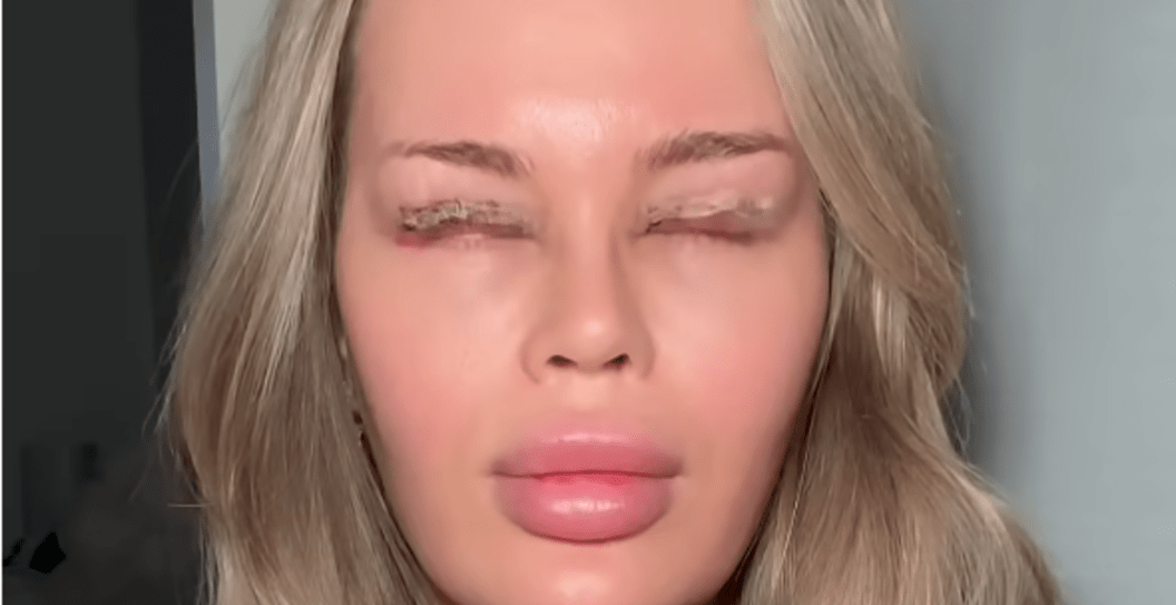YouTube Star Experiences Gruesome Side Effects After Eyelid Surgery