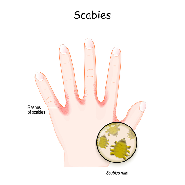 Scabies mite.